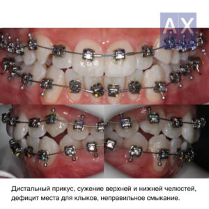 скученность зубов и неправильное расположение клыков - врач Ахматова