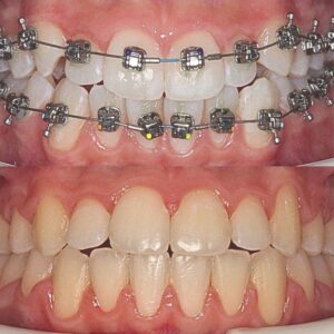 скученность зубов и неправильное расположение клыков - врач Ахматова