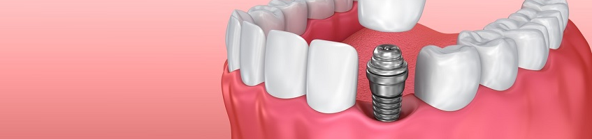 Модель имплантации зуба