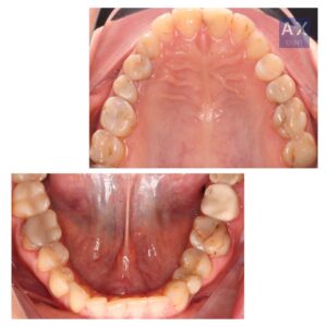 комплексный кейс лечение зубов брекеты виниры