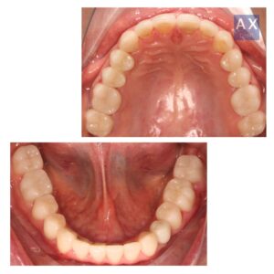 комплексный кейс лечение зубов брекеты виниры