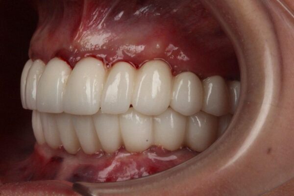 Имплантация под ключ при полном отсутствии зубов (2)